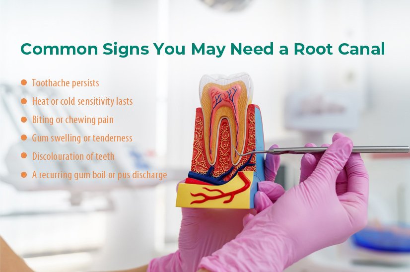 Common Signs Root Canal Treatment