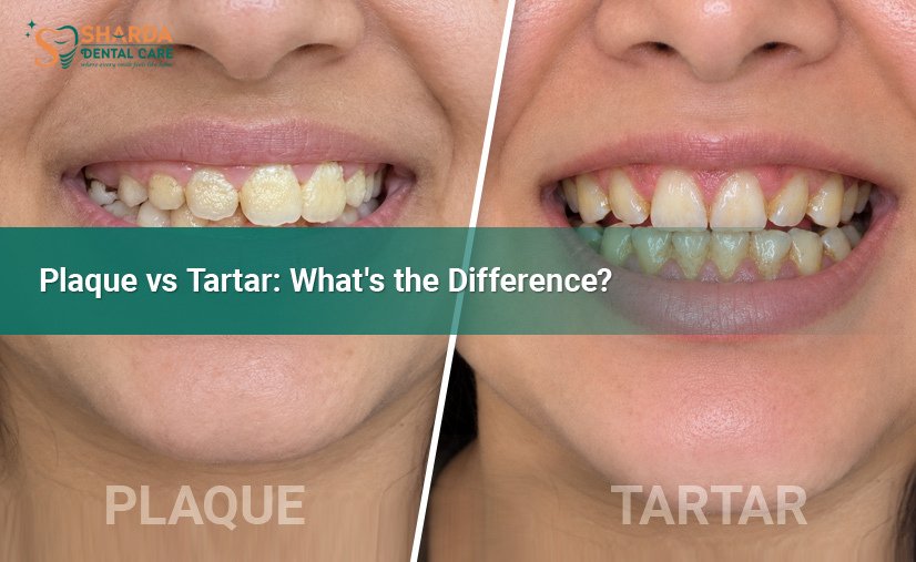 Plaque-vs-Tartar-Whats-the-Difference-Indirapuram